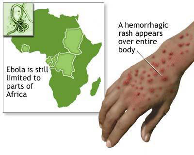 علایم بیماری ابولا از بیماریهای مشترک حیوان و انسان نشانه های بیماری ابولا,تشخیص بیماری ابولا