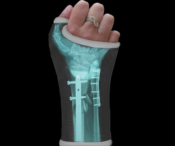 X-ray Cast X-ray Cast